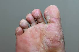 fungal infection Foot